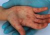reportan contagios nuevos de viruela simica