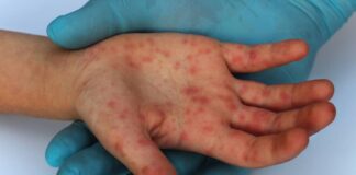 reportan contagios nuevos de viruela simica